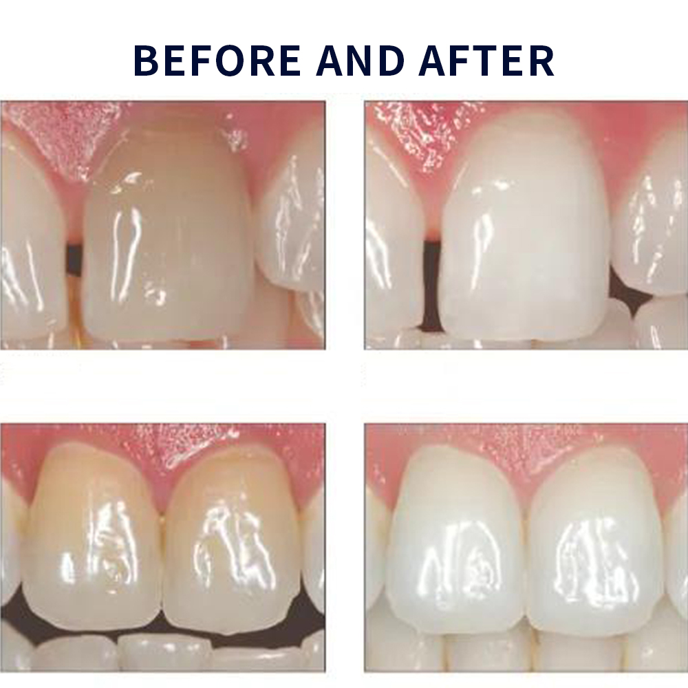 Opale scence White ning 1,2 pf – Teeth Whitening Hydrogen Peroxide Bewertung und Preis