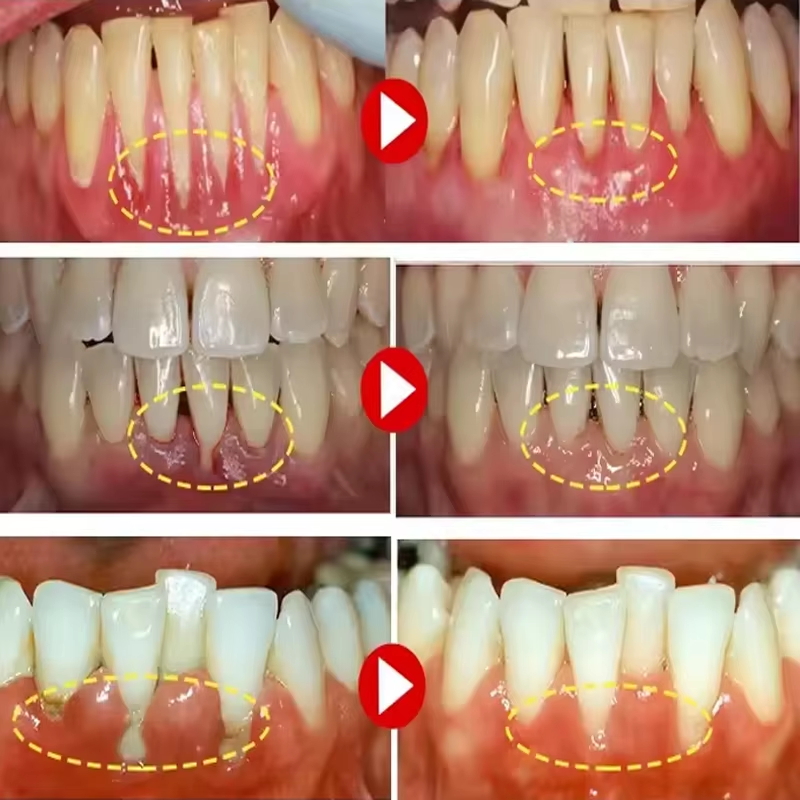 Zahnaufhellungs-Gel, Zahnfleis – Teeth Whitening Gels Bewertung und Preis