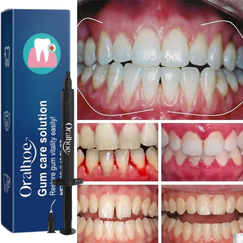 Zahnaufhellungs-Gel, Zahnfleis – Teeth Whitening Gels Bewertung und Preis