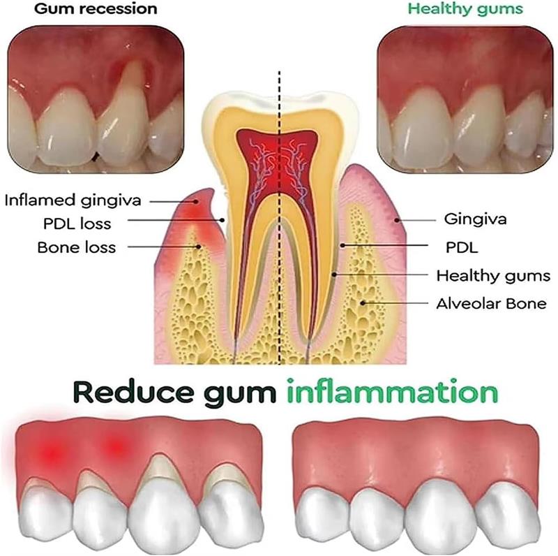 Zahnaufhellungs-Gel, Zahnfleis – Teeth Whitening Gels Bewertung und Preis