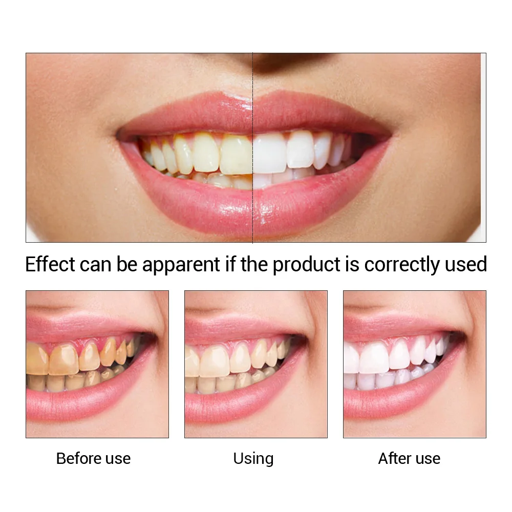 FTEENPLY Zahnaufhellung Essenz – Teeth Whitening Ai Bewertung und Preis