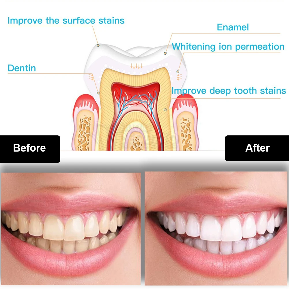 Dental Zahnaufhellung Kit Mini – Teeth Whitening Hydrogen Peroxide Bewertung und Preis